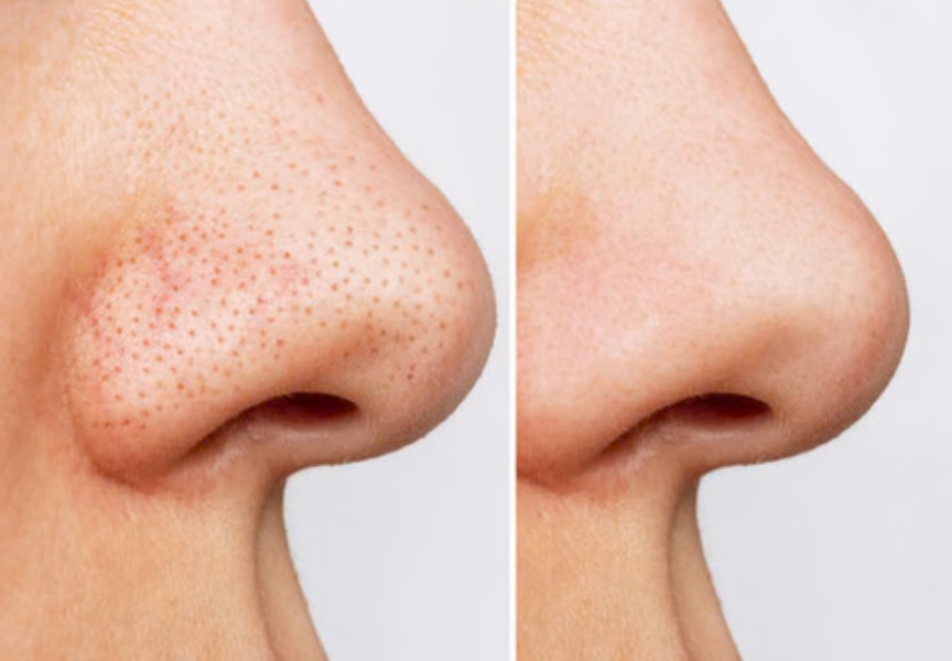 Masque Anti-Points Noirs Skin Drop™